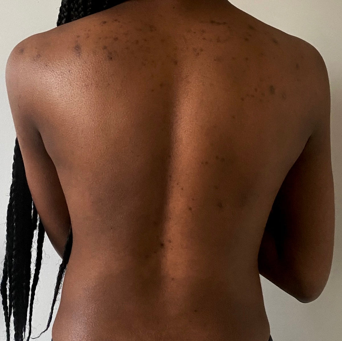 Banish Back Acne: Tips for Clearer, Healthier Skin